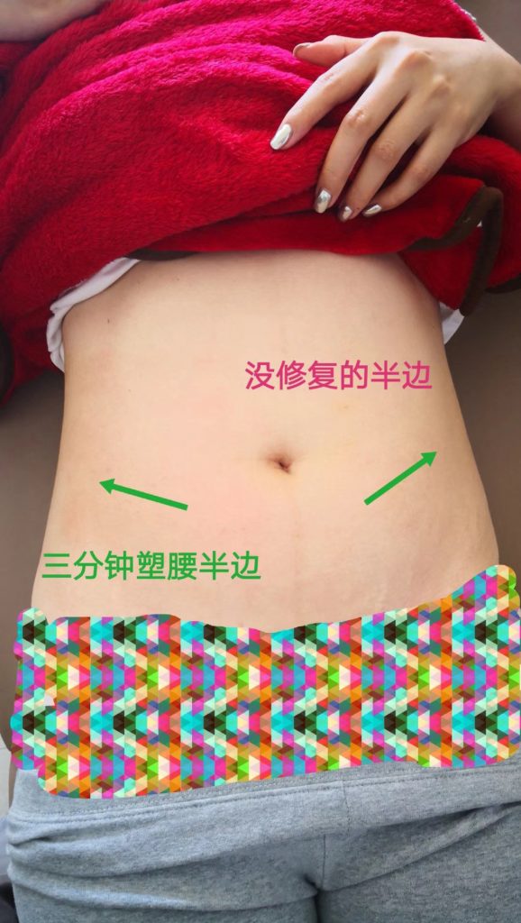 香港產後紮肚與腹直肌修復對比圖,展示三分鐘塑腰與未修復腰腹線條差異