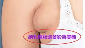 產後副乳腫脹與腋下硬塊無痛通乳