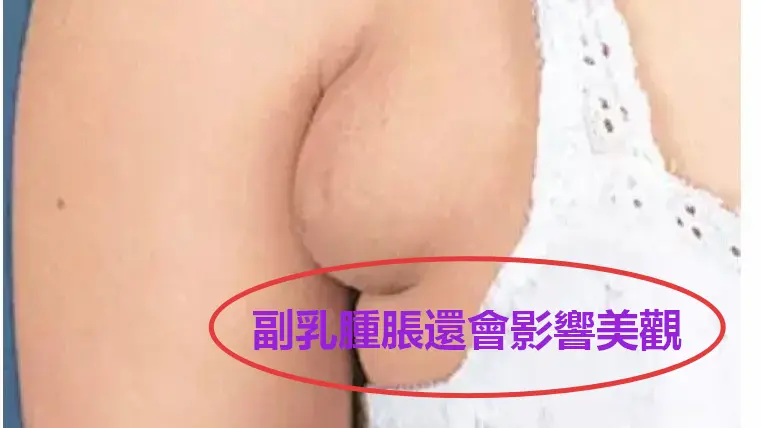 產後副乳腫脹與腋下硬塊無痛通乳